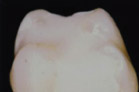 Cavity pre-treated with Silver Diamine Fluoride / Potassium lodide