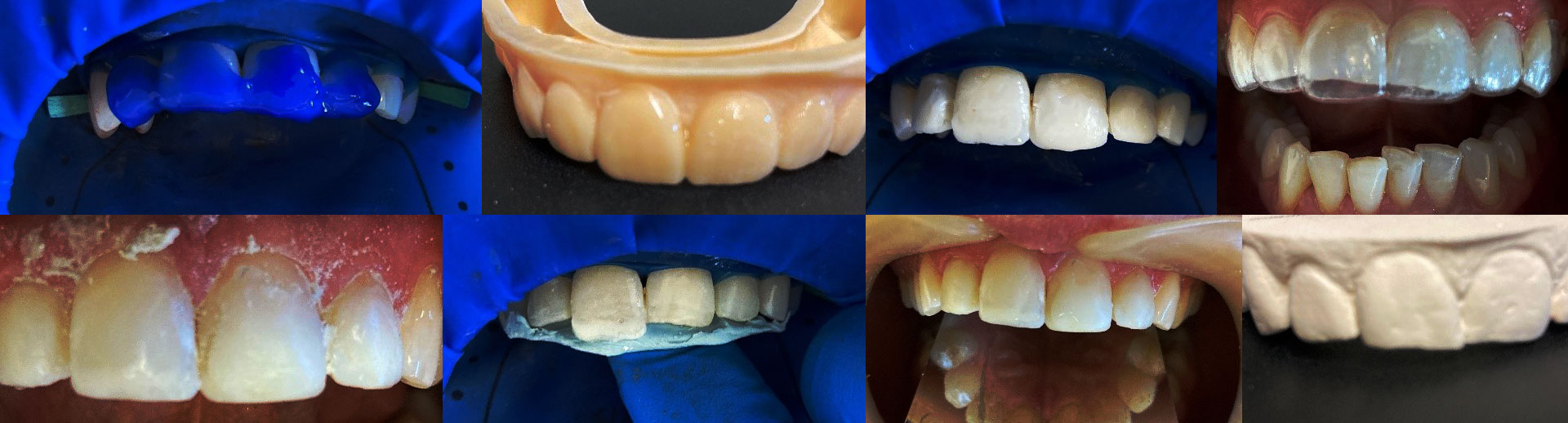 Restoration of fractured incisors using Luna 2 universal composite