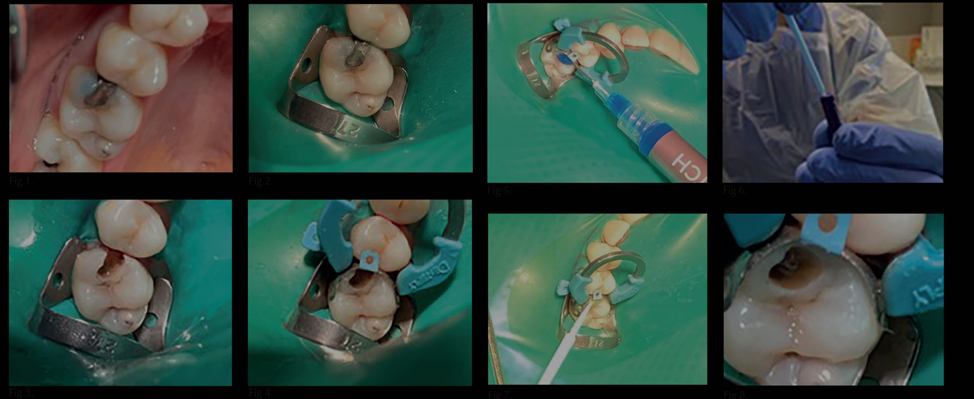 Restoration of a maxillary first molar