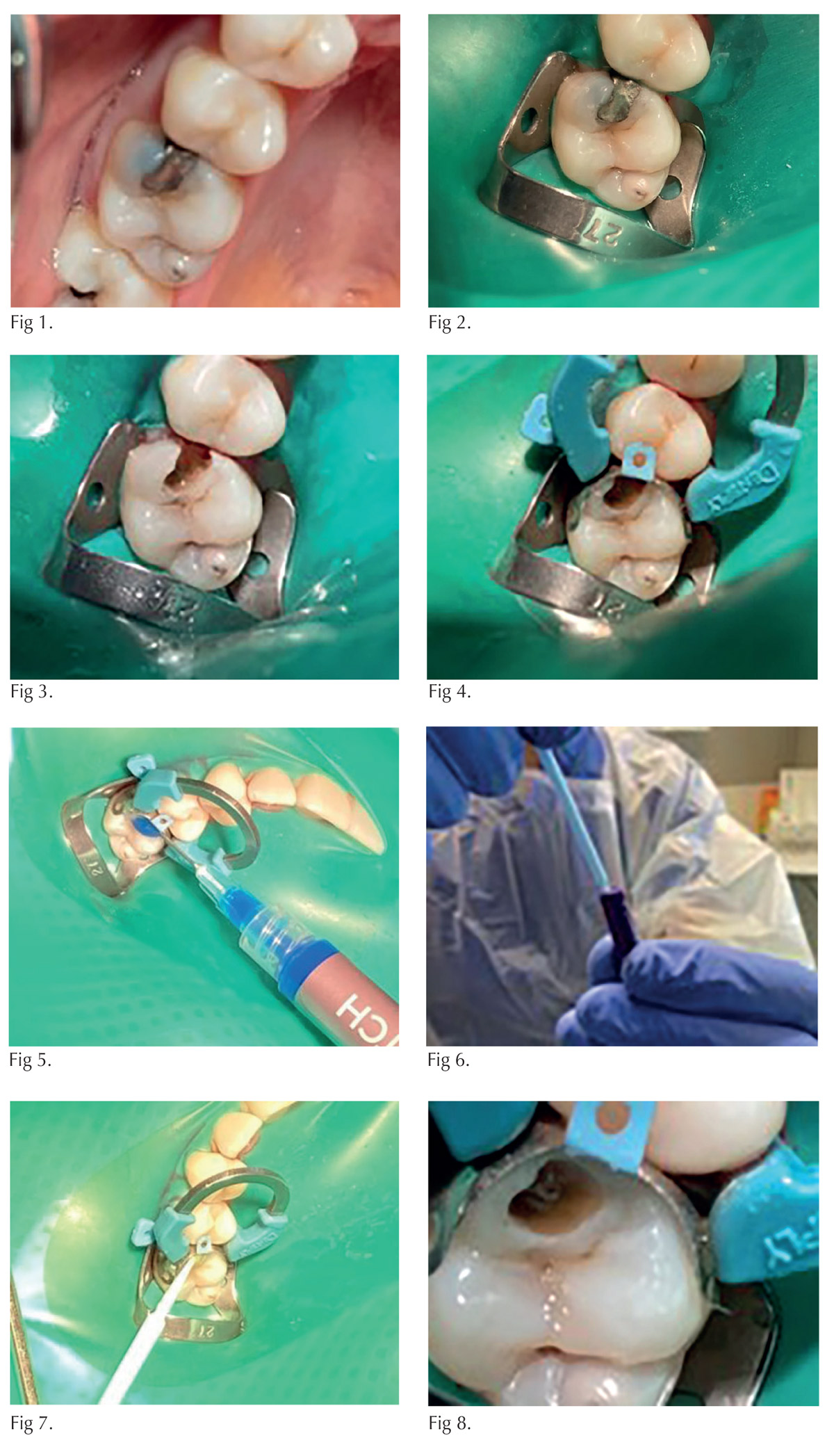 Restoration of maxillary first molar - images 1