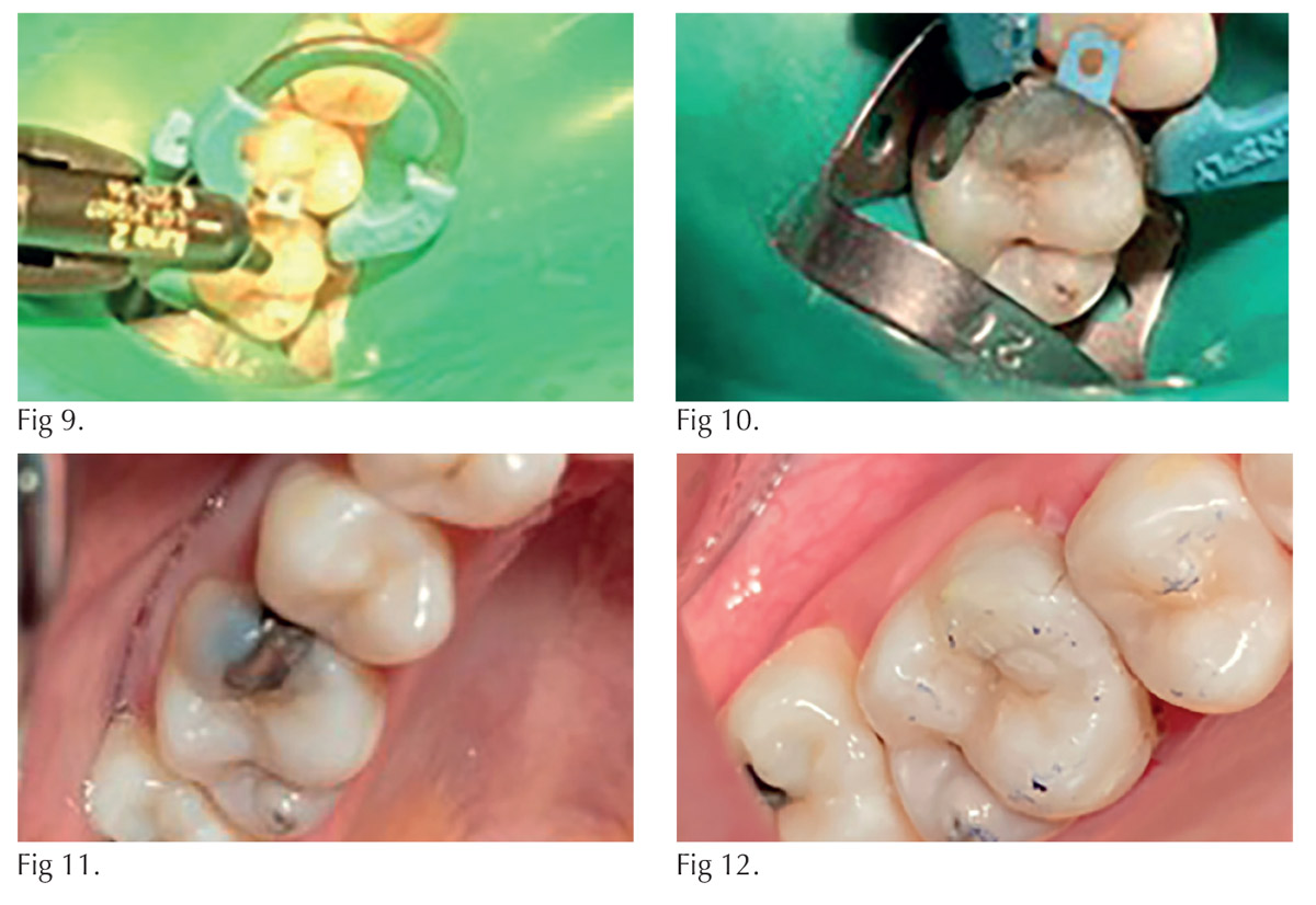 Restoration of maxillary first molar - images 2